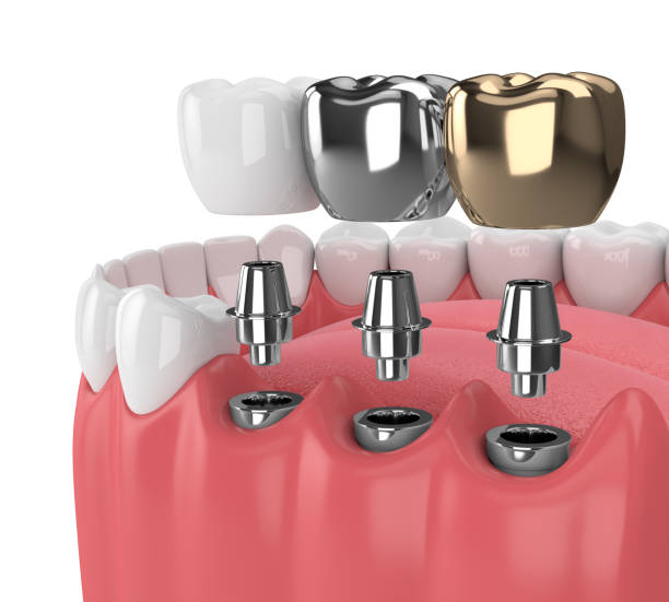 Read more about the article Dental Implant Guide | Your Dental Implant Options Explained