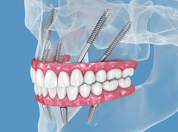 You are currently viewing What Are Zygomatic Implants?