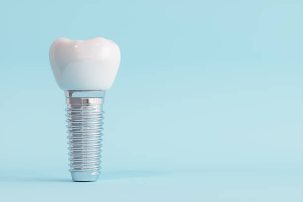 Read more about the article How Long Do Dental Implants Last?