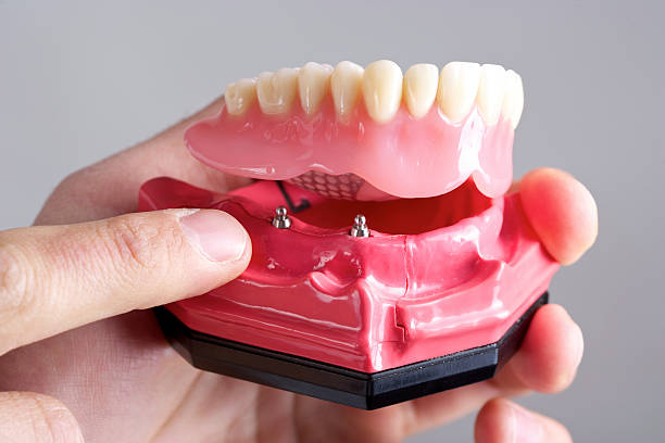 Read more about the article Dental Implants vs. Dentures: What’s the Better Option?