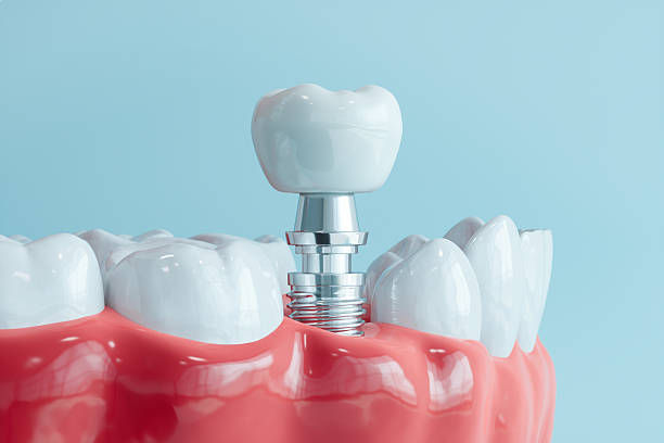 Read more about the article What Are Dental Implants? A Complete Beginner’s Guide