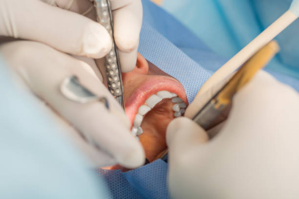 dental implant