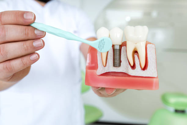 Read more about the article How to Care for Your Dental Implants: Maintenance Tips